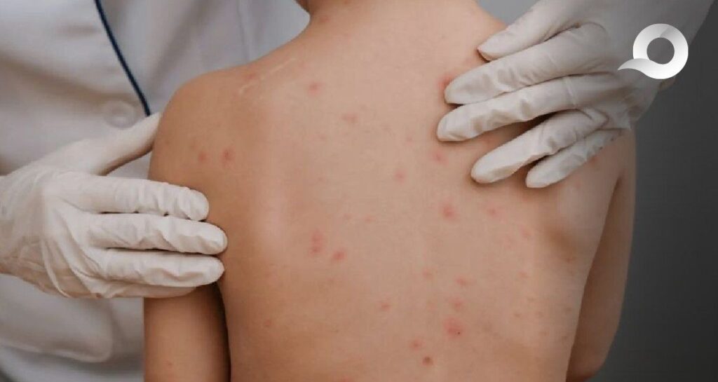 Hidalgo registra aumento del 35% en casos de varicela en 2025: ¿Cómo protegerse?